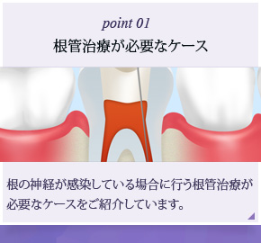 根管治療が必要なケース