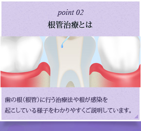 根管治療とは